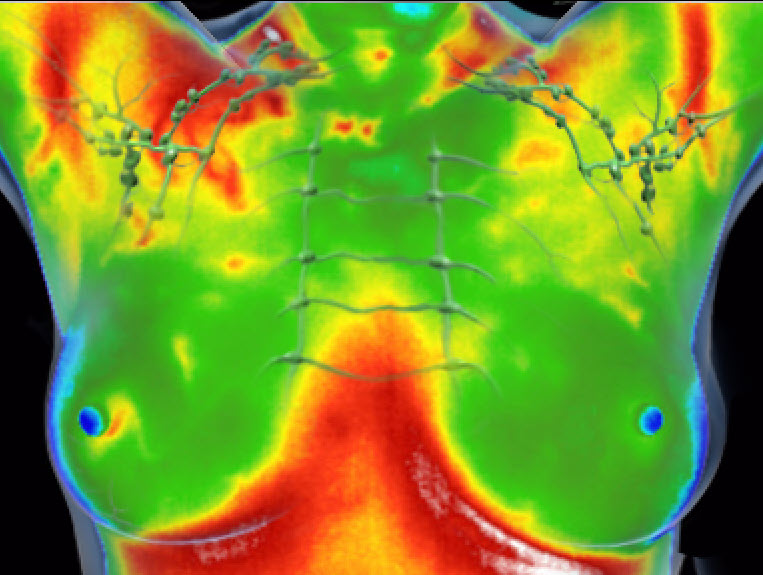 infrared breast screening